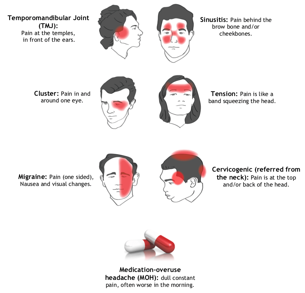 Types of Headaches