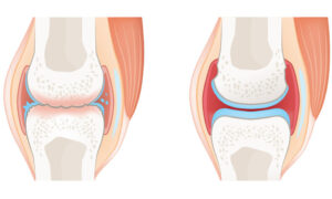 osteoarthritis vs rheumatoid arthritis