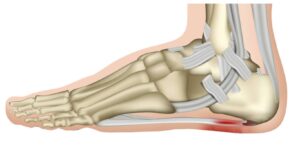 Plantar Fasciitis